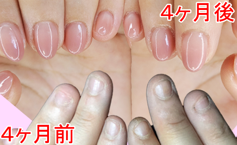 深爪＆癖のある爪でも楽しめる 4か月前は深爪、4ヶ月後は綺麗なハンドネイル